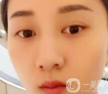 安醫(yī)一附院整形外科價(jià)格表2020版，還有激光祛斑案例