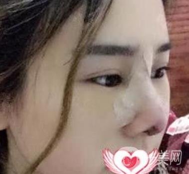 上海市第一人民醫(yī)院整形科隆鼻大概要多少錢(qián)?附價(jià)格明細(xì)一覽表