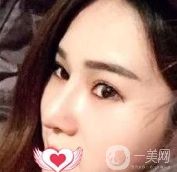 上海市第一人民醫(yī)院整形科隆鼻大概要多少錢(qián)?附價(jià)格明細(xì)一覽表