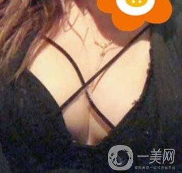 廣州南方醫(yī)院美容科怎么樣?附2020全新價格表及隆胸案例