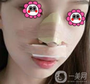 沈陽杏林崔昌墉做鼻子怎么樣?2020整形價格表一覽