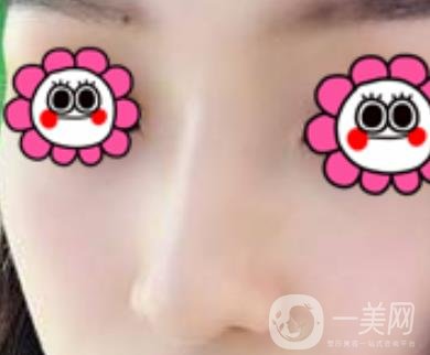 沈陽杏林崔昌墉做鼻子怎么樣?2020整形價格表一覽