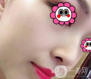 沈陽杏林崔昌墉做鼻子怎么樣?2020整形價格表一覽