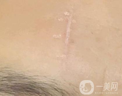 鄭大一附院祛疤怎樣?附2020整形價(jià)格表及案例*果圖