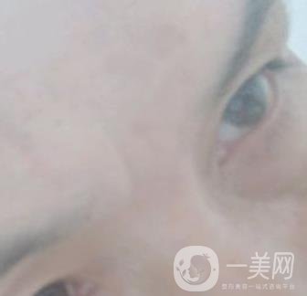 鄭大一附院祛疤怎樣?附2020整形價(jià)格表及案例*果圖