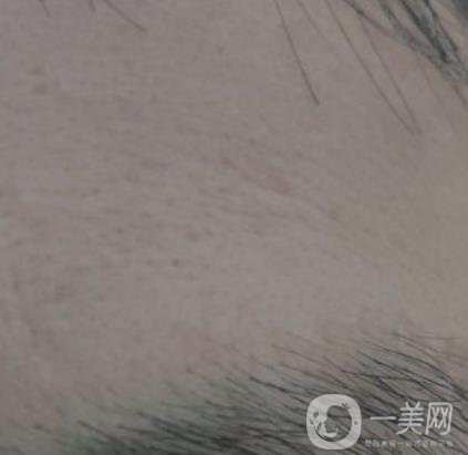 鄭大一附院祛疤怎樣?附2020整形價(jià)格表及案例*果圖