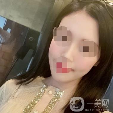 南大一附院整形美容科價(jià)格表2020版及祛疤案例