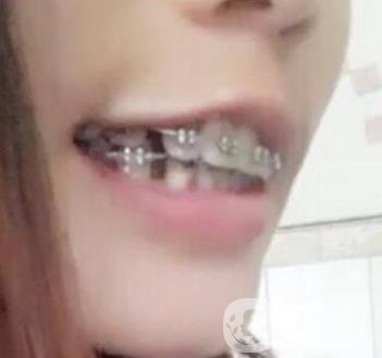 桂林美奧口腔醫(yī)院價(jià)格表全新版，附牙齒矯正案例