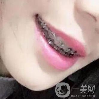 桂林美奧口腔醫(yī)院價(jià)格表全新版，附牙齒矯正案例