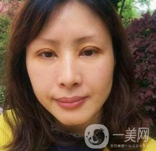沈陽軍區(qū)總醫(yī)院整形外科價格表，附雙眼皮真實案例