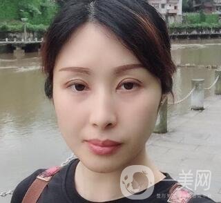 沈陽軍區(qū)總醫(yī)院整形外科價格表，附雙眼皮真實案例
