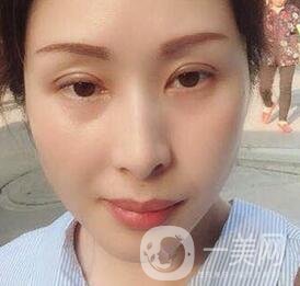 沈陽軍區(qū)總醫(yī)院整形外科價格表，附雙眼皮真實案例