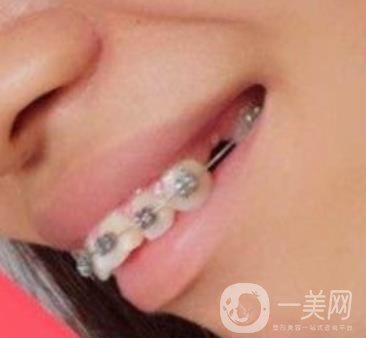 復(fù)旦大學(xué)附屬兒科醫(yī)院口腔科做牙齒矯正多少錢(qián)？?jī)r(jià)格表明細(xì)一覽