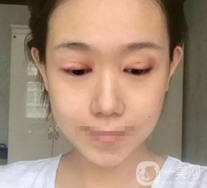 重慶醫(yī)科大學附屬第一醫(yī)院整形科價格價目表，附雙眼皮*果圖