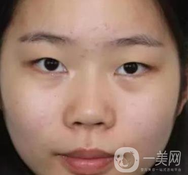 淮安第一人民醫(yī)院割雙眼皮怎樣?真人案例及整形價格表分享