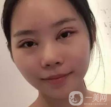 淮安第一人民醫(yī)院割雙眼皮怎樣?真人案例及整形價格表分享