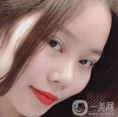 淮安第一人民醫(yī)院割雙眼皮怎樣?真人案例及整形價格表分享