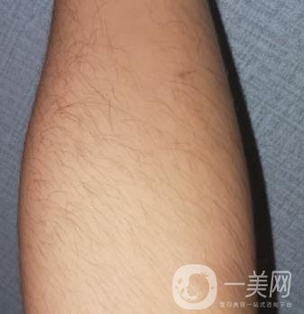 哈醫(yī)大四院整形美容科價格表鉅惠來襲，附冰點(diǎn)脫毛案例