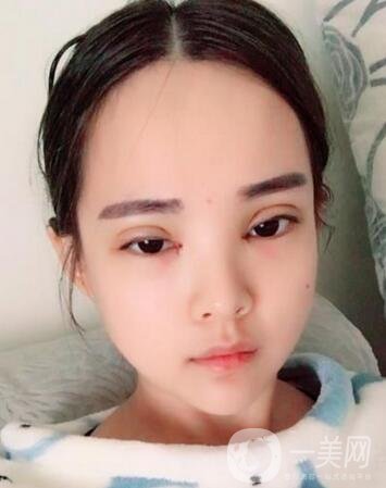 湖南第一醫(yī)院整形科價(jià)格表，附雙眼皮案例