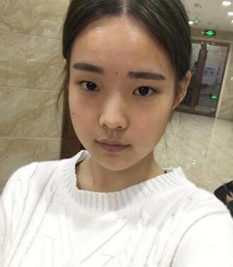 湖南第一醫(yī)院整形科價(jià)格表，附雙眼皮案例