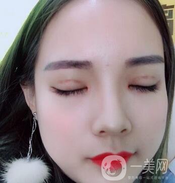 湖南第一醫(yī)院整形科價(jià)格表，附雙眼皮案例