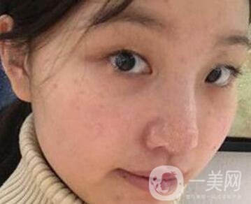 青島青醫(yī)附院整形價格表，還有雙眼皮實例