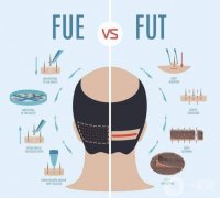 大麥微針和碧蓮盛信息介紹？植發(fā)選哪一家性價(jià)比高？