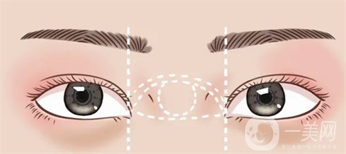 天津璦珊整形醫(yī)院雙眼皮整形日記_價(jià)格表介紹一覽