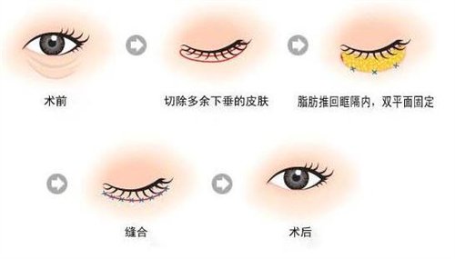 天津公安醫(yī)院整形價(jià)格表2020年，內(nèi)附做眼袋*圖