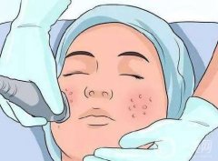 祛痘手術(shù)有哪些？