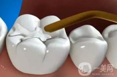 補(bǔ)牙是不是*性的？可以維持多久？