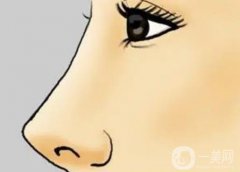 隆鼻后可以運(yùn)動嗎？隆鼻后怎么？