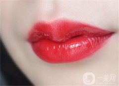 注射玻尿酸豐唇有哪些優(yōu)點？