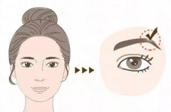 什么是切眉術(shù)？可以去除魚尾紋嗎