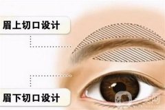 切眉的好處有哪些？幾天能拆線