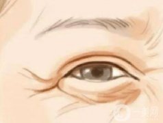 激光去魚尾紋術(shù)前術(shù)后的注意事項(xiàng)