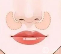 墊鼻基底有沒有必要？有幾種手術(shù)方法？