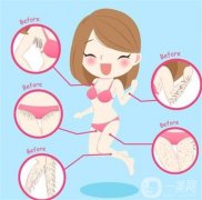 超冰點(diǎn)脫毛的副作用有哪些？