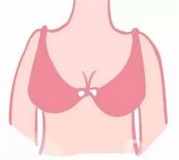 假體隆胸失敗有什么癥狀？隆胸后需要臥床多久？