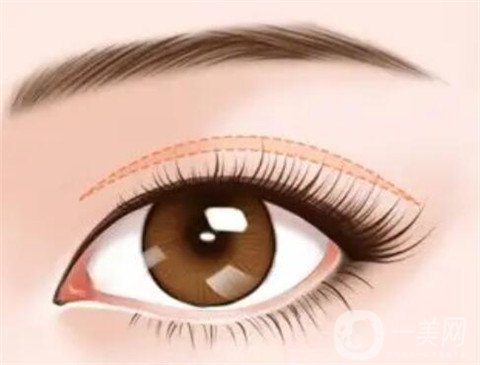 寧波市第一醫(yī)院整形美容科割雙眼皮怎么樣？價格表及案例詳情