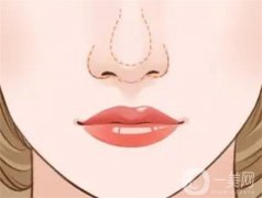 手術(shù)需要多少錢？注意事項(xiàng)有哪些？