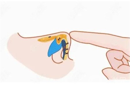 湖南省人民醫(yī)院整形科價(jià)格表2020版，還有整鼻子案例