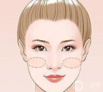 蘋果肌凹陷怎么處理？蘋果肌在哪里？