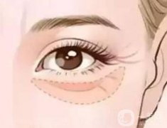 祛除眼袋前后的注意事項(xiàng)有哪些？