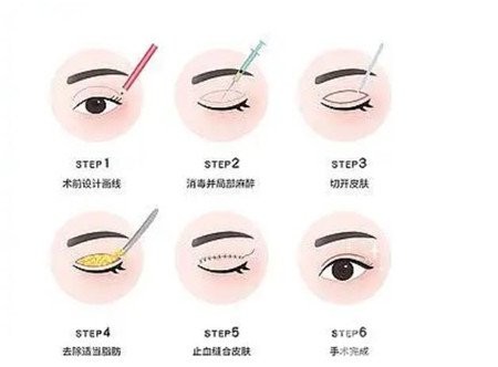 合肥105醫(yī)院割雙眼皮怎么樣?附2020整形價格表及真人案例