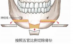 什么是切骨？需要多少費用？