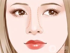 鼻小柱延長有什么后遺癥？