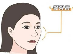 下頜角截骨術(shù)有哪些特點和風(fēng)險？適合哪個年齡？