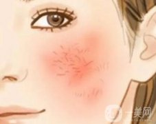 光子嫩膚去紅血絲要多少錢？