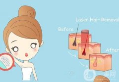 激光脫毛有哪些特點？什么是光子脫毛？